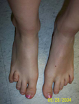 Alyssa, Pre-op thumbnail image, limb lengthening, Metatarsal Lengthening, foot deformity