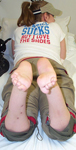 Nicole, Follow up thumbnail image, Limb Lengthening, sacral agnesis, foot deformity corrected, bone healed