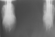 Nicole, Follow up thumbnail of an  x-ray, Limb Lengthening, sacral agnesis, foot deformity corrected, bone healed