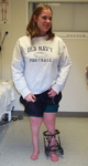 Nicole, Post-op thumbnail image, Limb Lengthening, sacral agnesis, foot deformity, minimally invasive osteotomy