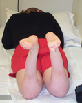 Nicole, Pre-op thumbnail Image, Limb Lengthening, sacral agnesis, foot deformity