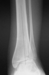 Nicole, Pre-op thumbnail of an x-ray, Limb Lengthening, sacral agnesis, foot deformity