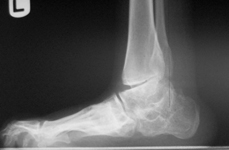 Nicole, Pre-op thumbnail of an x-ray, Limb Lengthening, sacral agnesis, foot deformity
