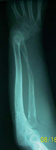 Petar, Follow up thumbnail of an x-ray, Limb Lengthening, wrist deformity correction, wrist/forearm lengthened