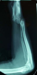 Petar, Follow up x-ray, Limb Lengthening, wrist deformity correction, wrist/forearm lengthened