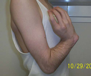 Petar, Pre-op thumbnail Image, Limb Lengthening, Radial Clubhand, Wrist/Forearm Derformity