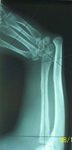 Petar, Pre-op thumbnail of an X-ray, Limb Lengthening, Radial Clubhand, Wrist/Forearm Derformity