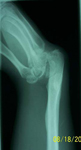 Petar, Pre-op thumbnail of an X-ray, Limb Lengthening, Radial Clubhand, Wrist/Forearm Derformity
