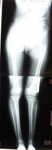 Jocelyn, Pre-Op thumbnail of an x-ray, Limb Lengthening, Pediatric, Femur Lengthening, growth arrest