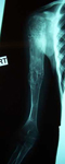Taylor, Follow up thumbnail of an x-ray, Limb Lengthening, Pediatric, Humerus lengthened, full mobility, deformity corrected