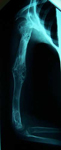 Taylor, Follow up thumbnail of an x-ray, Limb Lengthening, Pediatric, Humerus lengthened, full mobility, deformity corrected