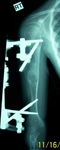 Taylor, Post-Op thumbnail of an x-ray, Limb Lengthening, Gradual Lengthening, EBI MAC Frame, humerus deformity correction, pediatric