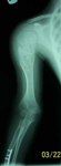 Taylor, Pre-Op thumbnail of an X-ray, Limb Lengthening, Humerus, Ollier's Disease, deformed humerus