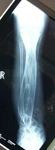 Lansana, Post-Op thumbnail of an x-ray, Limb Lengthening, ankle stable, ability to run now 
