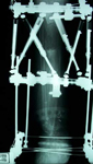 Lansana, Post-Op thumbnail of an x-ray, Limb Lengthening, ilizarov method, gradual correction, bone transport, ankle fusion