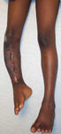 Lansana, Pre-Op thumbnail Image, Limb Lengthening, Limb Salvage, tibial bone defect