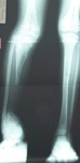 Lansana, Pre-Op x-ray, Limb Lengthening, Limb Salvage, tibial bone defect