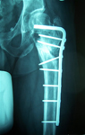 Robert, Follow up thumbnail of an x-ray, Limb Lengthening, Deformity Corrected, Blade Plate
