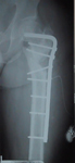Robert, Post-op thumbnail of an x-ray, Limb Lengthening, Hardware Removed, LLD Corrected, Blade Plate, Internal Bone Stimulator