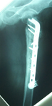 Robert, Post-op thumbnail of an x-ray, Limb Lengthening, Hardware Removed, LLD Corrected, Blade Plate, Internal Bone Stimulator