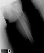 Robert, Pre-op thumbnail of an x-ray, Limb Lengthening, Femur Nonunion, Deformity