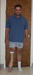 Steven, Follow up thumbnail image, Limb Lengthening, leg straightened, arthritis prevention