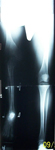 Steven, Post-op thumbnail of an x-ray, Limb Lengthening, tibia and fibula osteotomy, ilizarov/taylor spatial frame