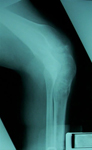 Steven, Post-op thumbnail of an x-ray, Limb Lengthening, tibia and fibula osteotomy, ilizarov/taylor spatial frame