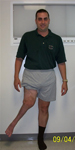 Steven, Pre-op thumbnail image, Limb Lengthening, congential leg deformity, valgus