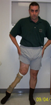 Steven, Pre-op thumbnail image, Limb Lengthening, congential leg deformity, valgus