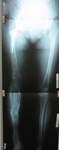 Carol, Follow up thumbnail of an x-ray, Limb Lengthening, returned to activities, deformities corrected