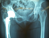Carol, Post-Op thumbnail of an x-ray, Limb Lengthening, total hip replacement, 2 level tibial osteotomy