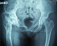 Carol, Pre-Op thumbnail of an x-ray, Limb Lengthening, deformity, correction in fibrous dyspalsia