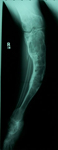 Carol, Pre-Op thumbnail of an x-ray, Limb Lengthening, deformity, correction in fibrous dyspalsia