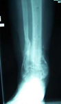 Jeanne, Follow up thumbnail X-ray, Limb Lengthening, proximal tibia lengthening