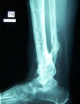 Jeanne, Follow up thumbnail of an X-ray, Limb Lengthening, proximal tibia lengthening