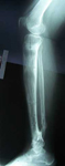 Jeanne, Follow up thumbnail of an X-ray, Limb Lengthening, proximal tibia lengthening