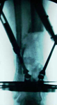 Jeanne, Post-op thumbnail of an X-ray, Limb Lengthening, Ilizarov/Taylor Spatial Frame, proximal tibial osteotomy