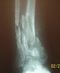 Jeanne, Pre-op thumbnail of an X-ray, Limb Lengthening, infected tibial nonunion, bone defect
