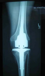 Jay, Post-op thumbnail of an x-ray, Limb Lengthening, Total Knee Replacement