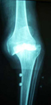 Jay, Pre-op thumbnail of an x-ray, Limb Lengthening, Unstable Neuropathic Knee