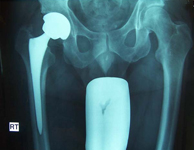 Dan, Post-op thumbnail of an X-ray, Limb Lengthening, Total Hip Replacement, metal on metal articulation