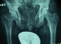 Dan, Pre-op thumbnail of an X-ray, Limb Lengthening, Stiff painful hip, leg length discrepancy
