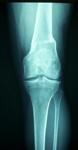 Andrew, Follow up thumbnail of an x-ray, Limb Lengthening, undue stress removed from lateral joint compartment of the knee