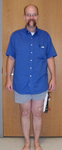 Andrew, Post-Op thumbnail Image, Limb Lengthening, osteotomy, distal femur, minimally invasive surgery 