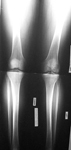 Andrew, Pre-Op thumbnail of an x-ray, Valgus Deformity, Knock Knee, Limb Lengthening 