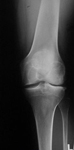 Andrew, Pre-Op thumbnail of an x-ray, Valgus Deformity, Knock Knee, Limb Lengthening 