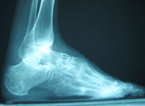 Don, Follow up thumbnail of an x-ray, Limb Lengthening, Foot Deformity Corrected, walking has greatly improved