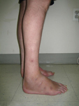 Don, Follow up Thumbnail Image, Limb Lengthening, Foot Deformity Corrected, walking has greatly improved