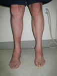 Don, Follow up thumbnail Image, Limb Lengthening, Foot Deformity Corrected, walking has greatly improved